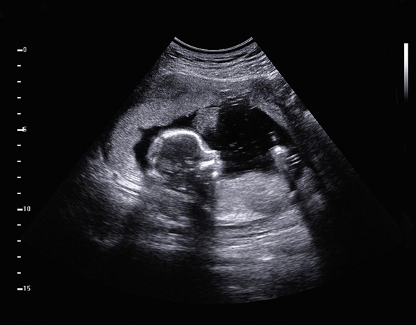 sonogram